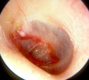 traumatic central perforation of ear drum