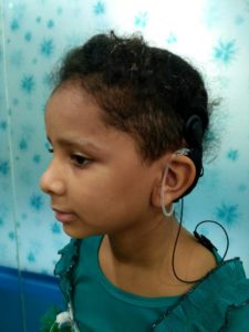 free cochlear implant surgery